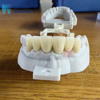 شراء التاج الطبيعي ذو الطبقات الزركونية الشفافة للغاية مع التاج الزرع online manufacture