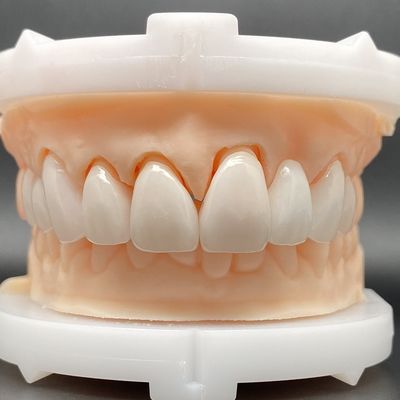 الحجابات المزينة من EMax المضغوطة بشكل سلبي في ألوان متعددة تجعل ابتسامة جميلة مع الحد الأدنى من إعداد الأسنان